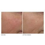 Advaced Retinol+Ferulic Overnight Wrinkle Treatment Advaced Retinol+Ferulic Overnight Wrinkle Treatment